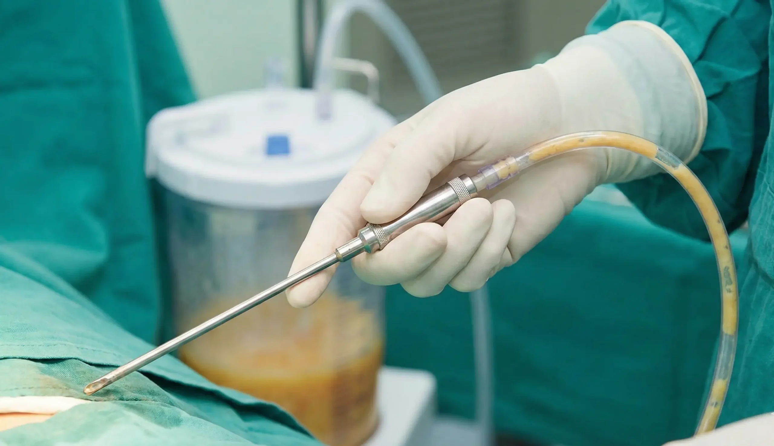 liposuction procedure large fat removal with thick cannula
