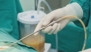 liposuction procedure large fat removal with thick cannula
