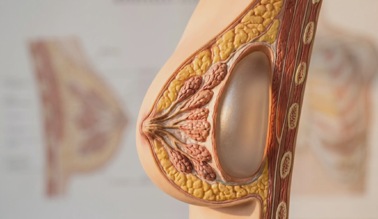 3d anatomical cross section breast with implant and glandular tissue