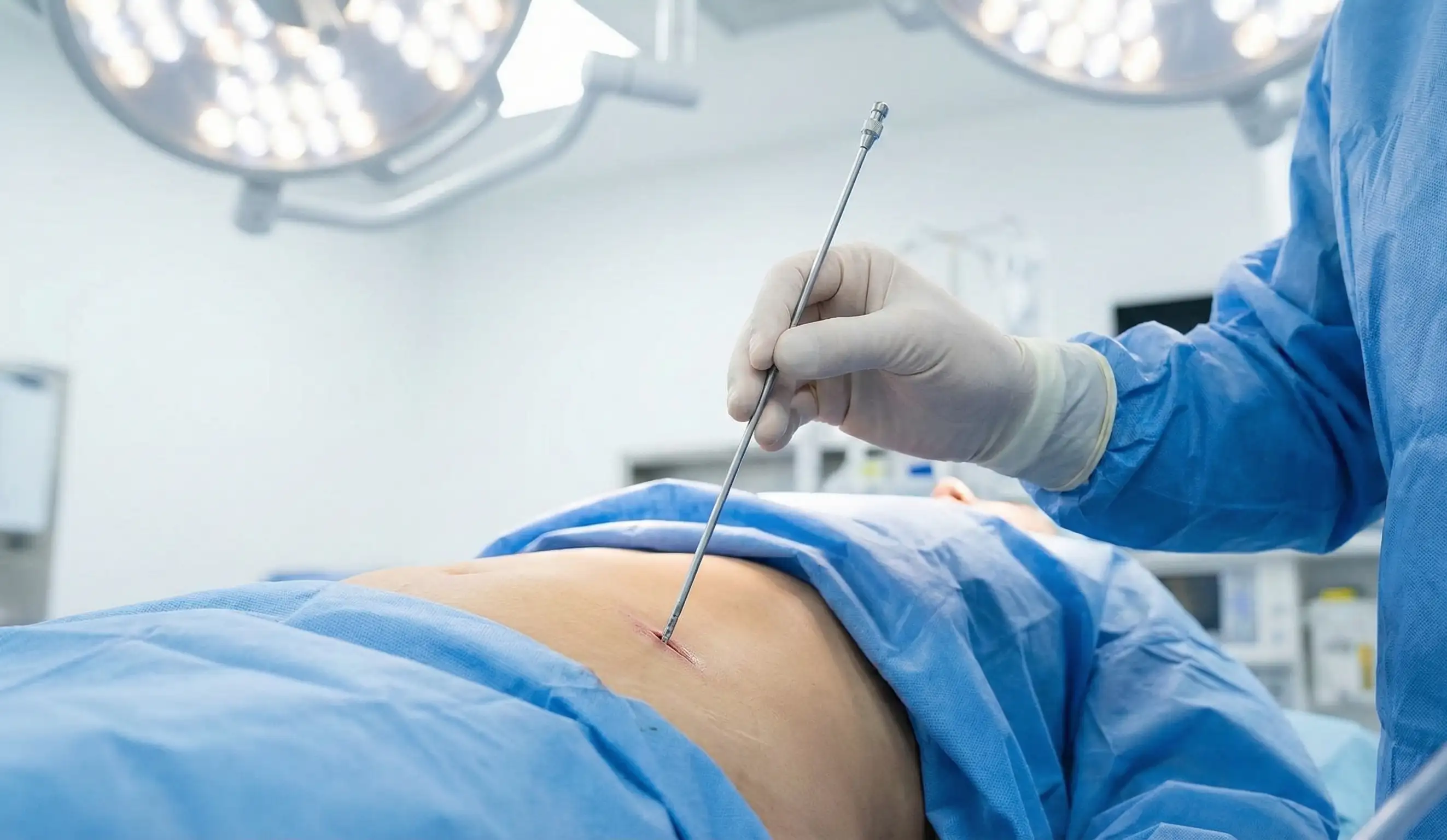 liposuction surgery cannula operating room