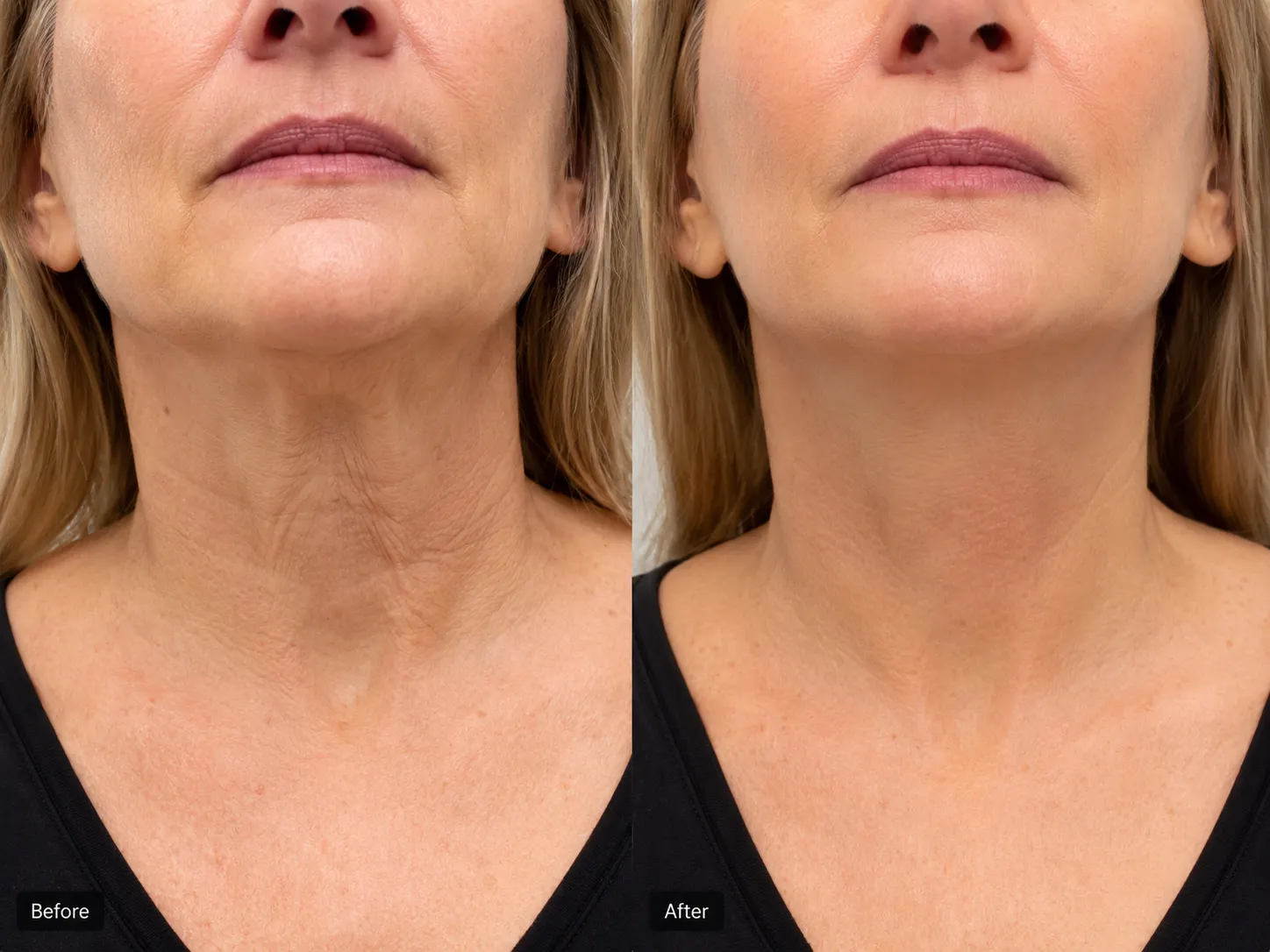 neck lift before and after