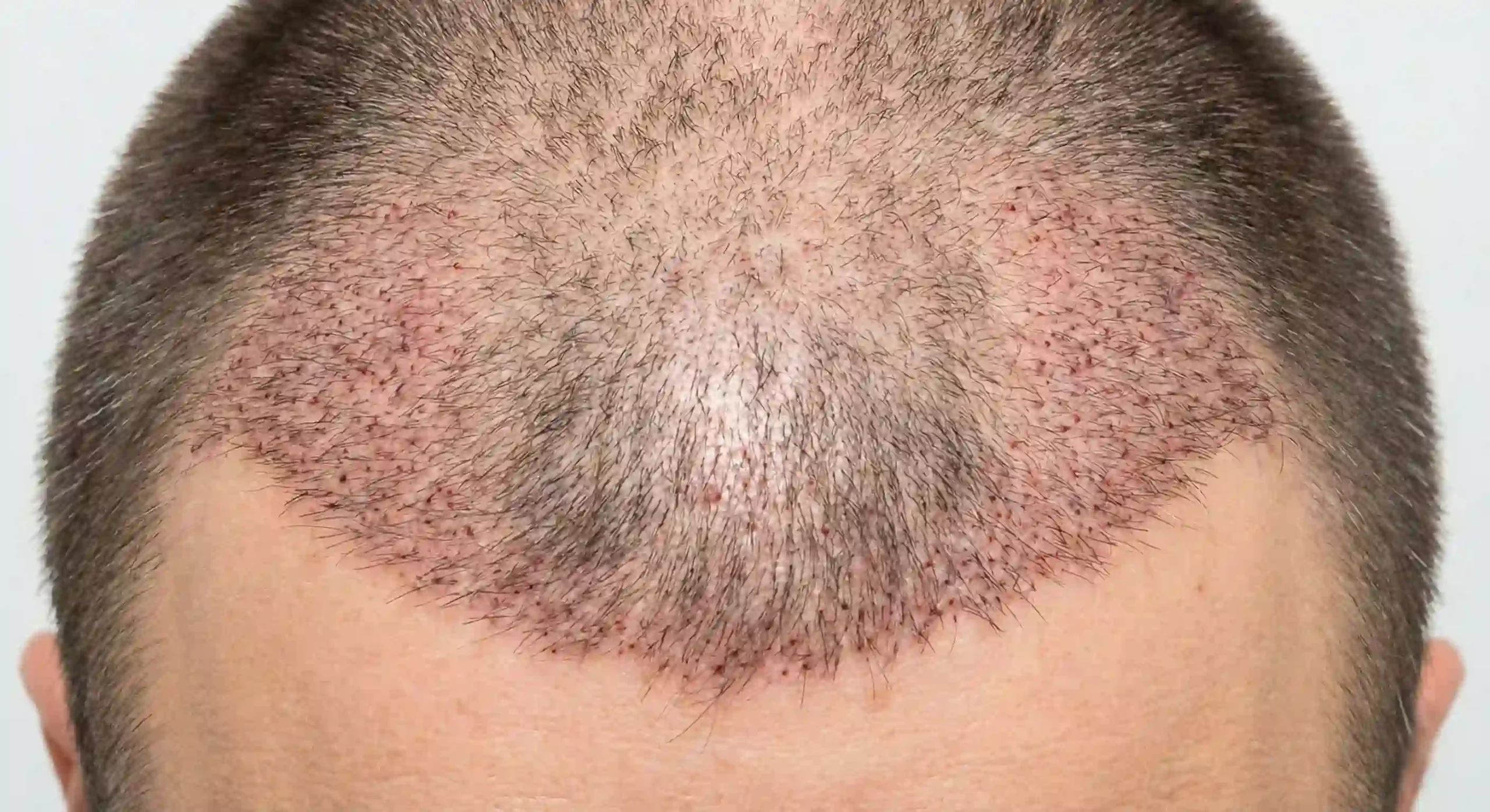 post hair transplant scalp showing shock loss
