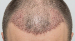 post hair transplant scalp showing shock loss