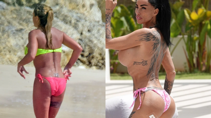 katie price bbl surgery before after