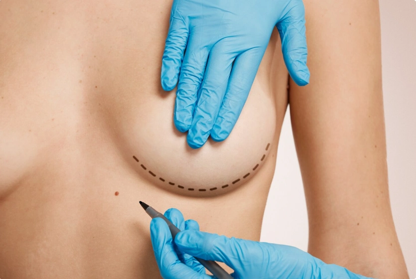 breast augmentation