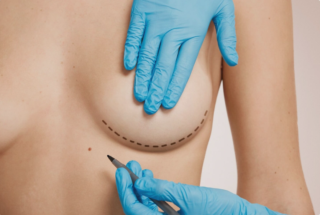 breast augmentation