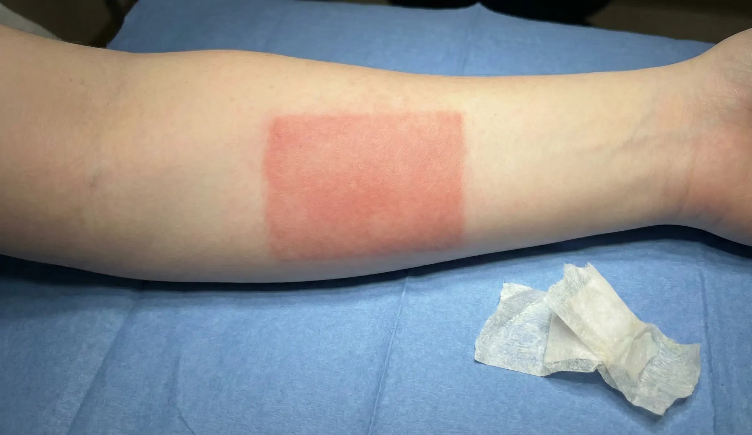 rectangular tape reaction redness