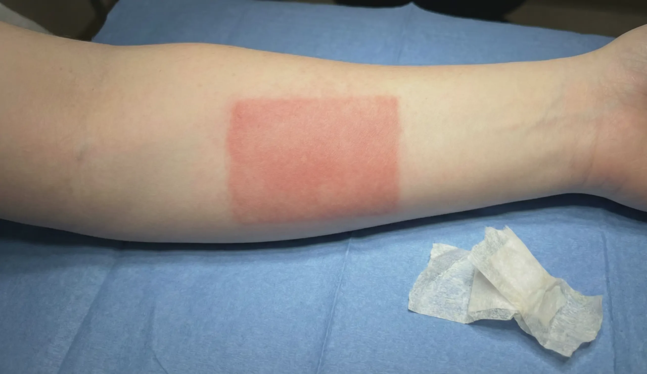 rectangular tape reaction redness
