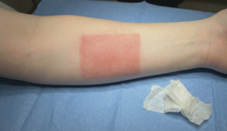 rectangular tape reaction redness