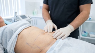 Lipo 360: When Does Swelling Peak After Liposuction?