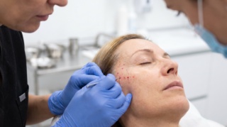 How Long After a Thread Lift Will My Face Feel Normal?