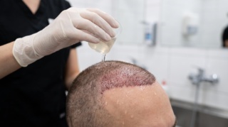 Hair Transplant: Can I Shower 10 Days After a Hair Transplant?
