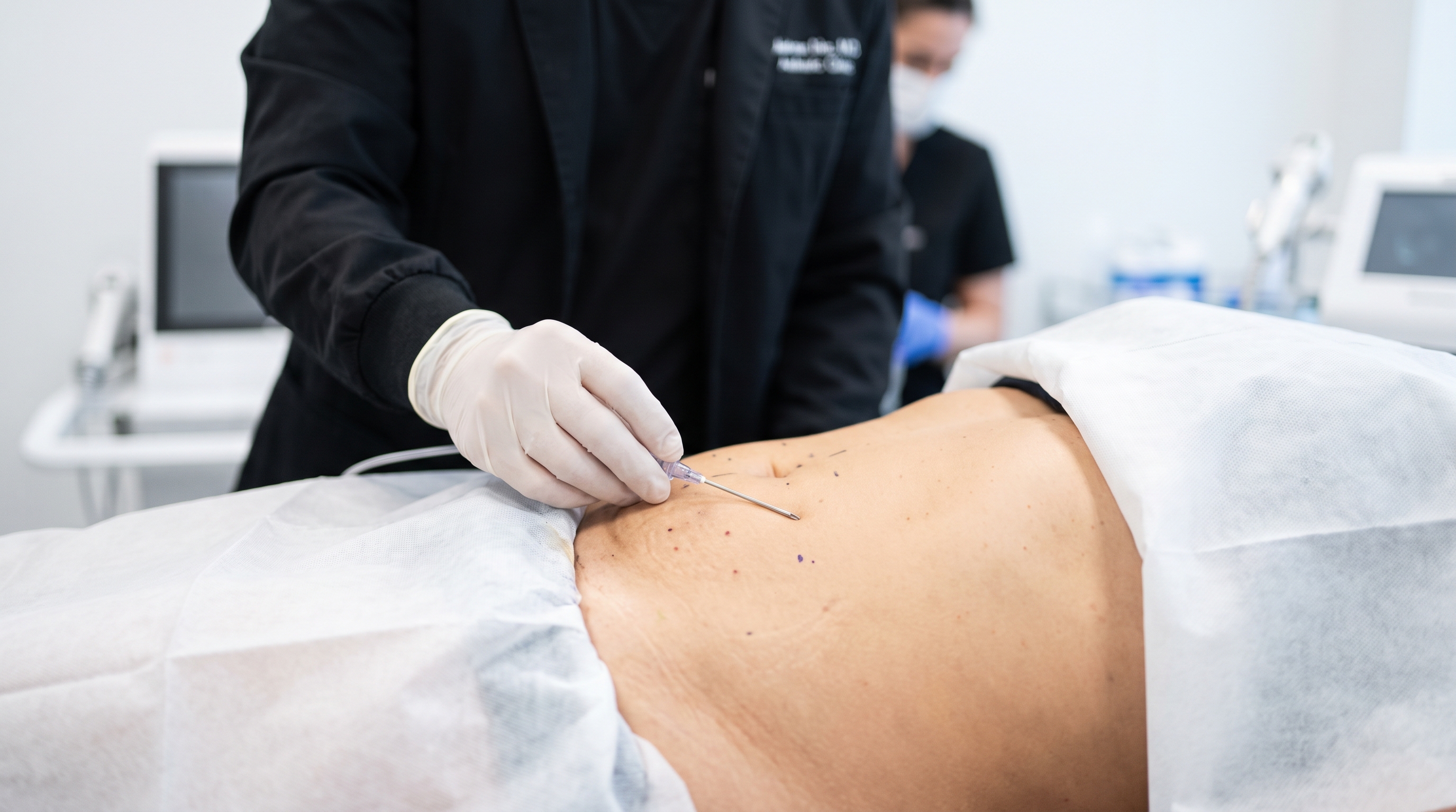 Body contours after Lipo 360, illustrating the expected post-operative swelling during recovery.