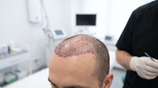 Hair Transplant: Is a Hair Transplant 100% Successful?