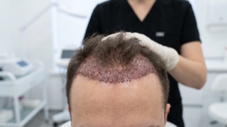 Hair Transplant: Can You Still Go Bald After a Hair Transplant?